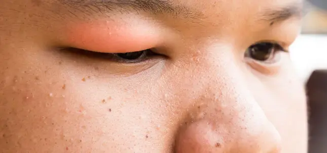 Frau mit einem geschwollengen oberen Augenlid