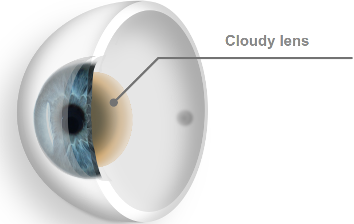 Grauer Star eingetrübte Linse