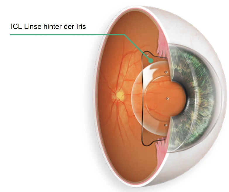 Querschnitt des Auges mit der ICL Linse hinter der Iris