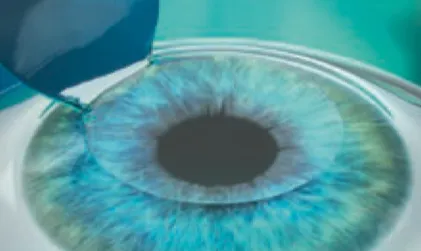 Aufklappen des Flaps beim Augenlasern mit LASIK in Frankfurt