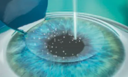 Modellieren der Hornhaut beim Augenlasern mit LASIk in Frankfurt