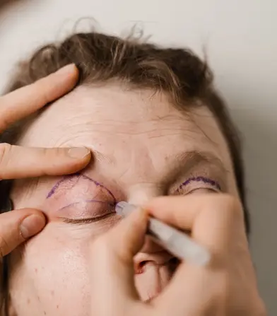 Patient wird auf Schlupflider OP vorbereitet und wird angezeichnet