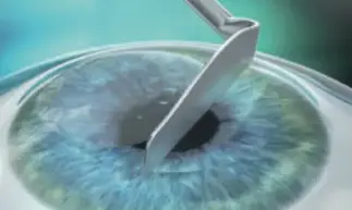 Aufklappen des Flaps beim Augenlasern mit LASIK in Frankfurt