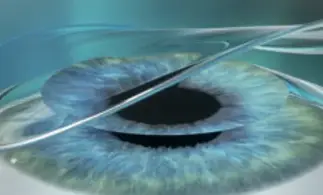 Zurücklegen des Flaps beim Augenlasern mit LASIK in Frankfurt
