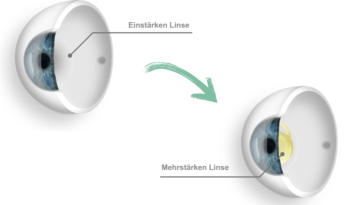 In diesem Video erklärt Prof. Dr. Mehdi Shajari, aus dem Augenlaserzentrum Dr. Vision in Frankfurt, alles Wichtige über den Linsenaustausch