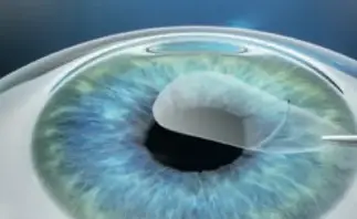 Lentikel Entnahme beim Augenlasern mit SMILE PRO in Frankfurt