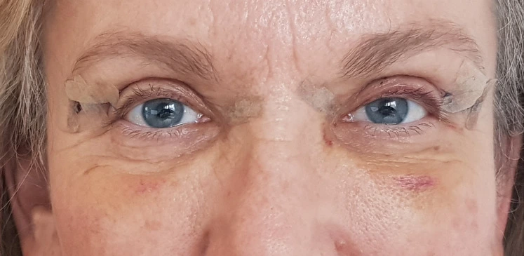 Schlupflider OP Frankfurt Kosten